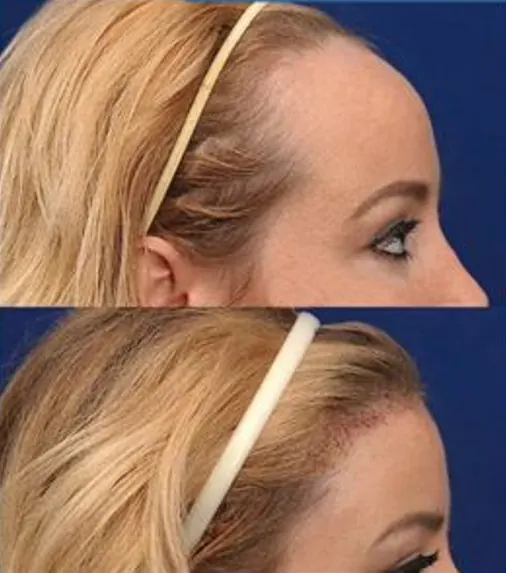 Transplante capilar FUE Goiânia – alta densidade em sessão única