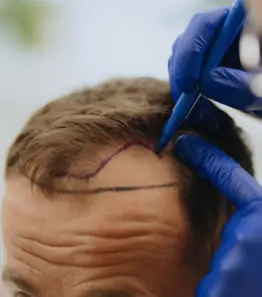 Resultado de transplante capilar FUE em Goiânia – método MAX FUE Dr. Gabriel Braga