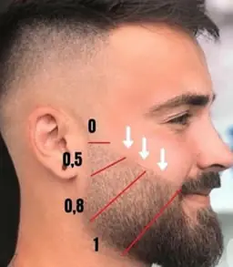 Implante capilar em Goiânia – cirurgia FUE realizada no Hospital Med Plastic