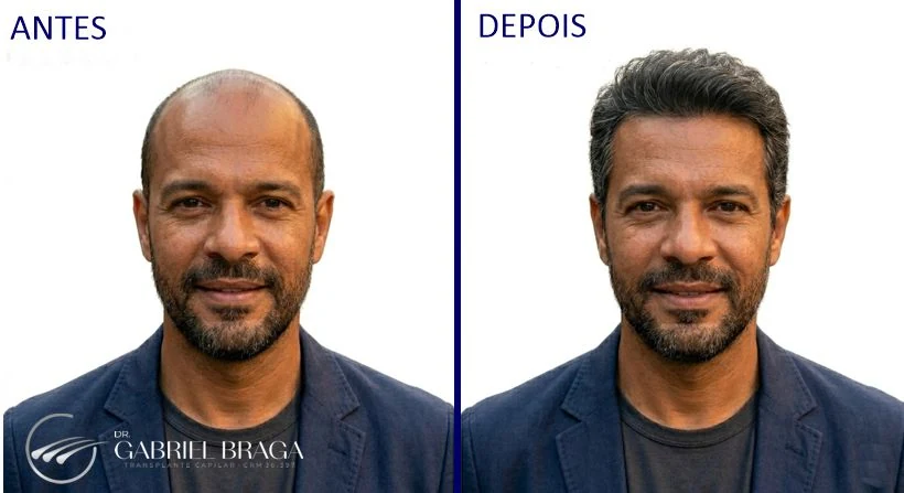 Resultado transplante capilar FUE Goiânia — antes e depois vista posterior, Método MAX FUE Dr. Gabriel Braga