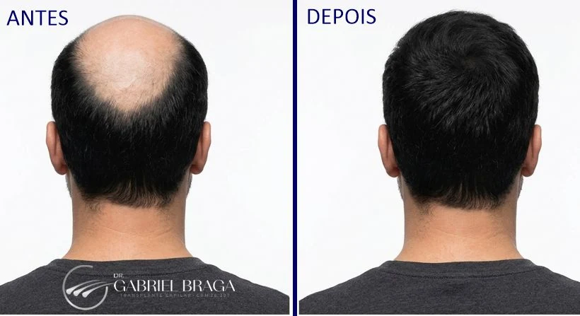 Resultado implante de cabelo Goiânia — antes e depois vista superior, alta densidade grafts Dr. Gabriel Braga