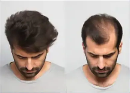 Resultado Transplante Capilar - Vista Superior Frontal